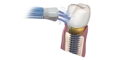 Ústní sprcha: perfektní péče o mini implantáty 