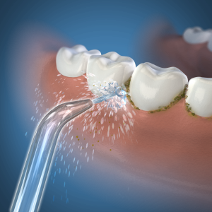 Waterpik Classic Jet náhradní trysky, 2 ks