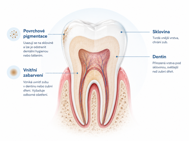 Průřez zubem znázorňující sklovinu, dentin, povrchové pigmentace a vnitřní zabarvení